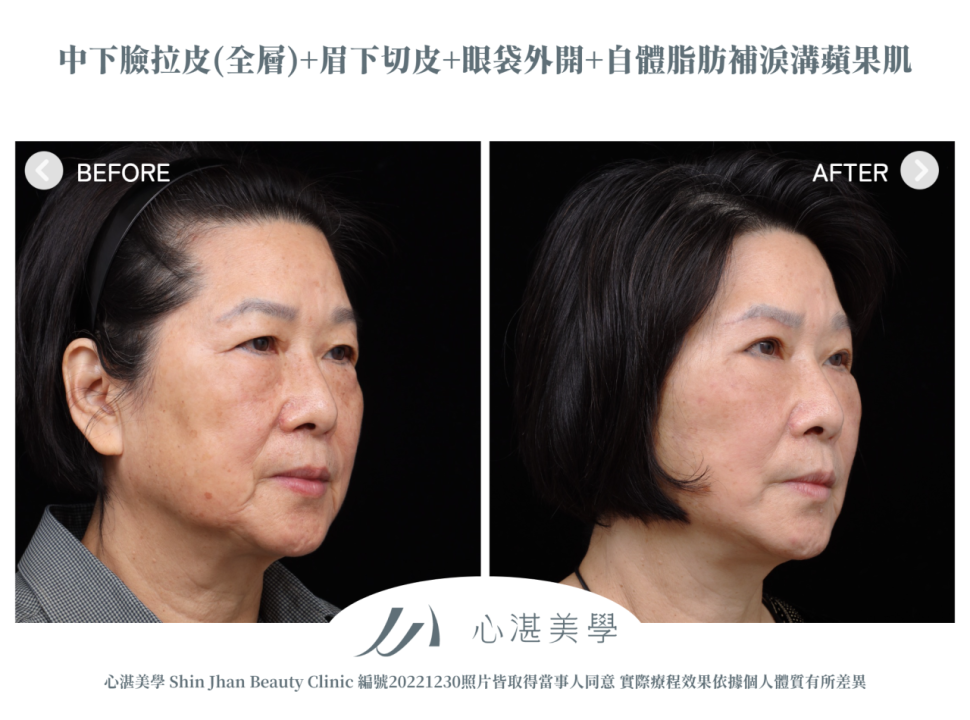 中下臉拉皮+眼袋外開+微創提眉手術(眉下切)+脂肪補淚溝術前術後案例分享