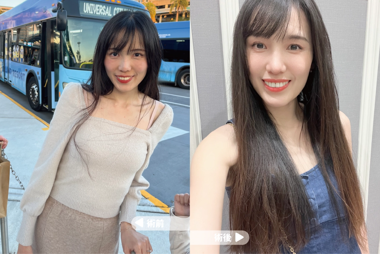 異肋+耳軟骨隆鼻打造我的韓式天生自然翹鼻！