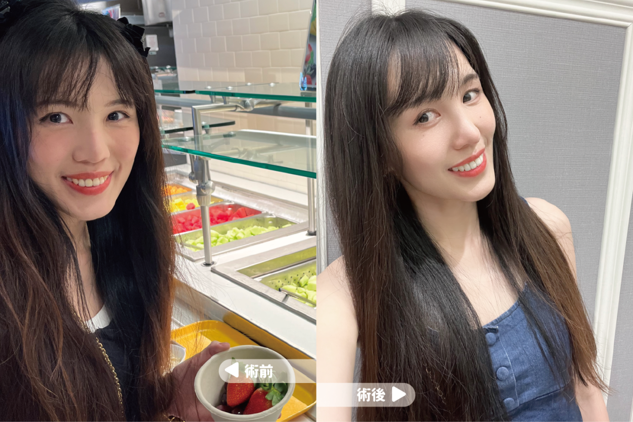 異肋+耳軟骨隆鼻打造我的韓式天生自然翹鼻！