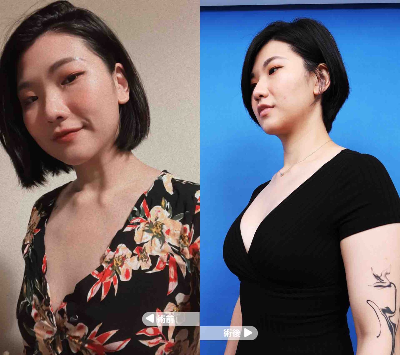 隆乳手術 術前術後案例分享 曼陀果凍矽膠