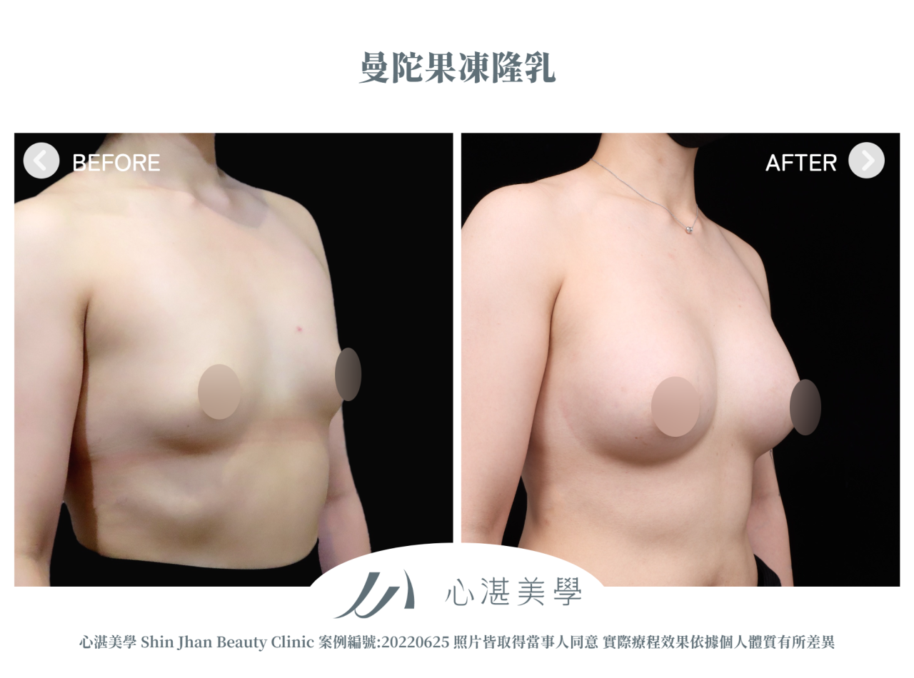 隆乳手術 術前術後案例分享 曼陀果凍矽膠