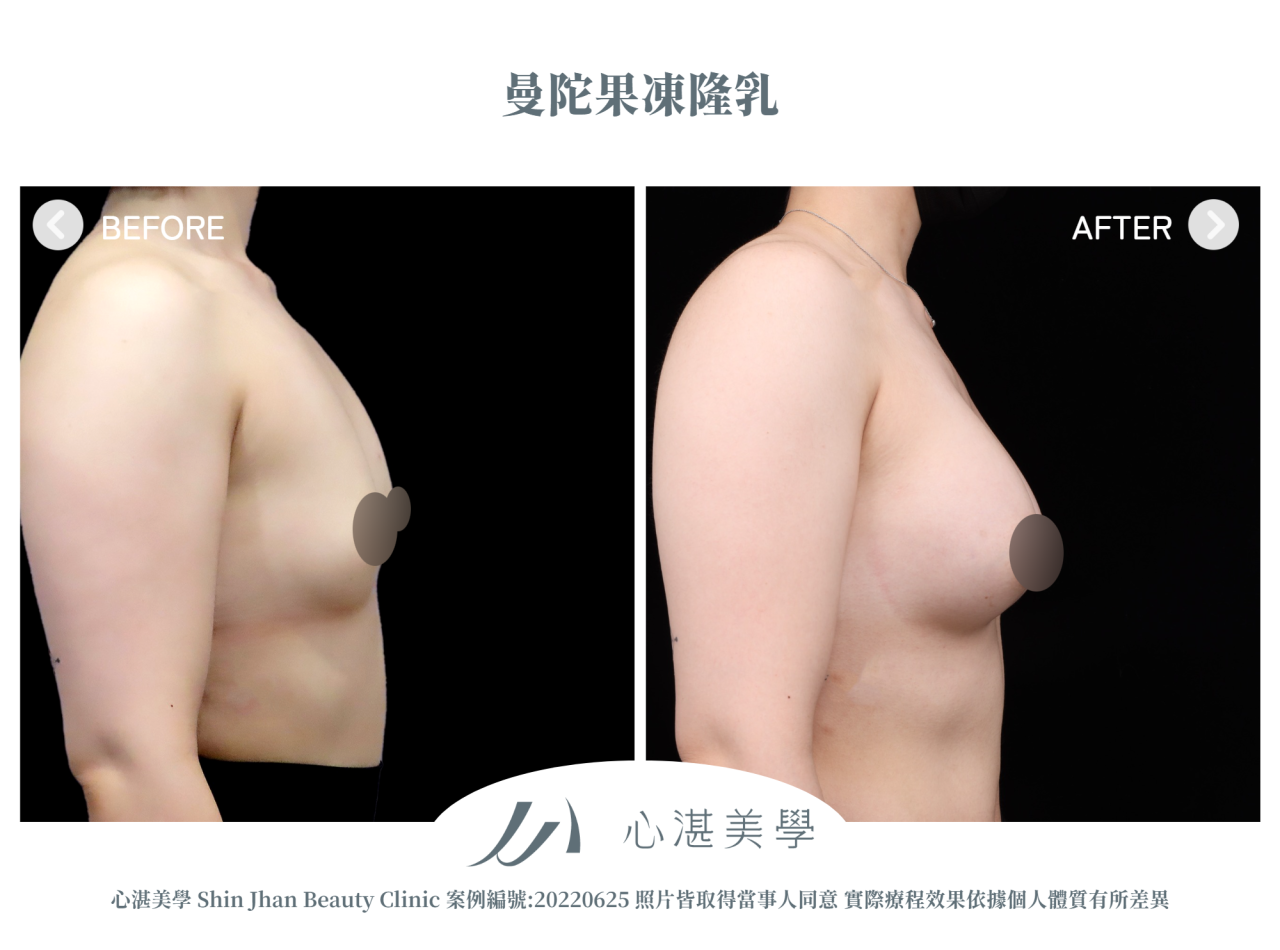 隆乳手術 術前術後案例分享 曼陀果凍矽膠