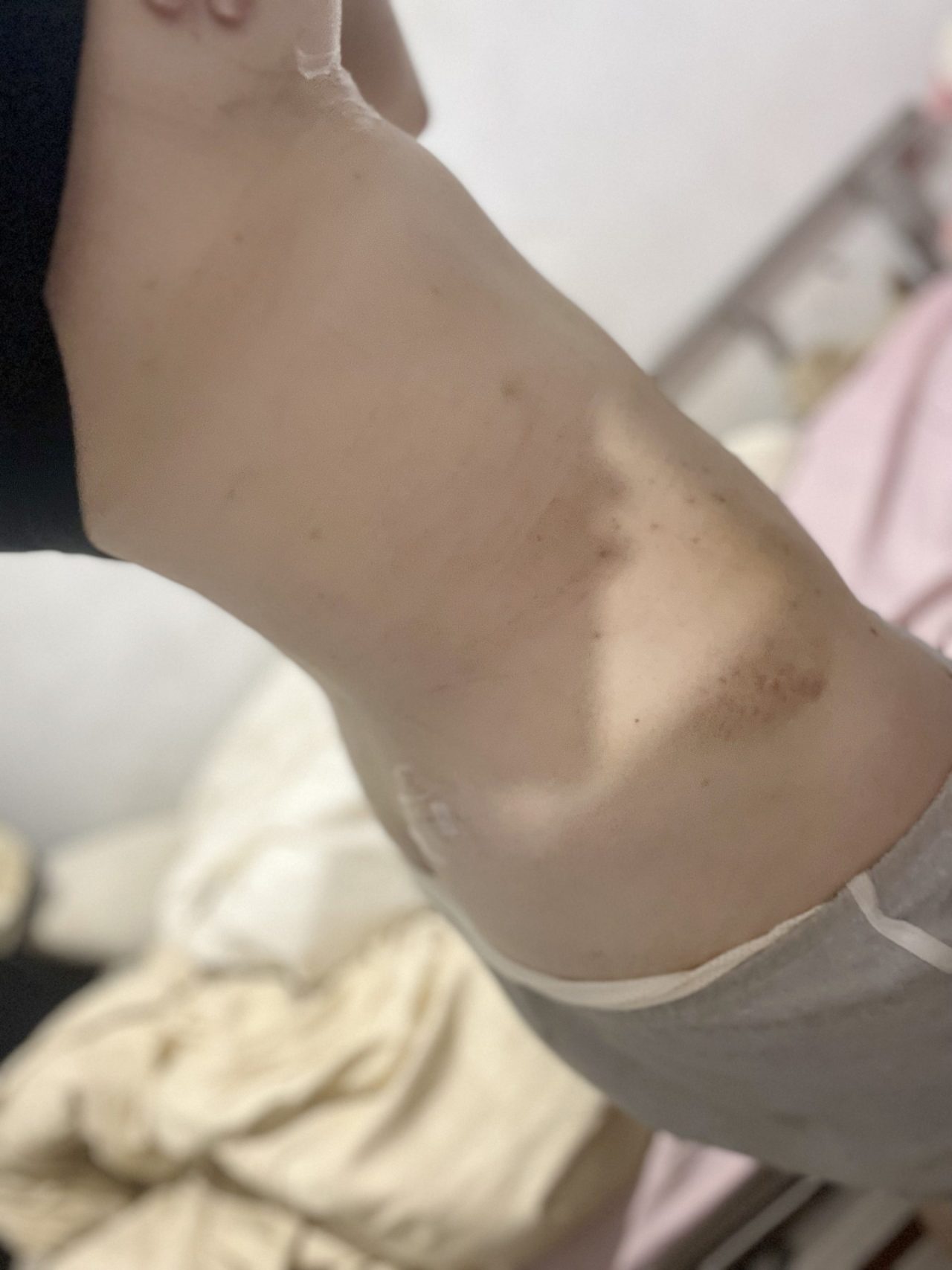 LSSA音浪脂雕進行腹部環抽，輕鬆打造馬甲線！