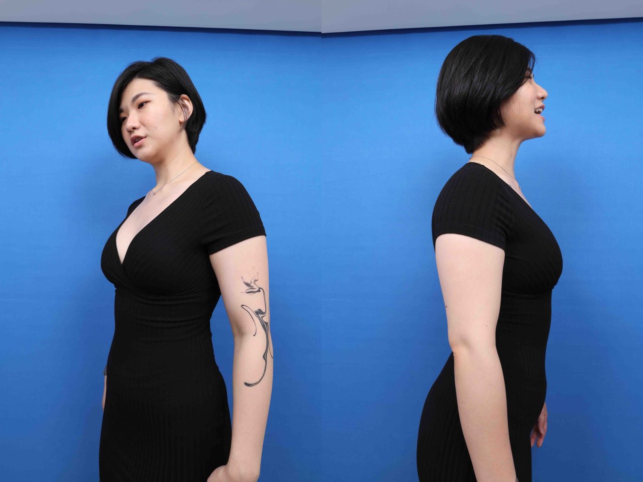 隆乳手術 術前術後案例分享 曼陀果凍矽膠