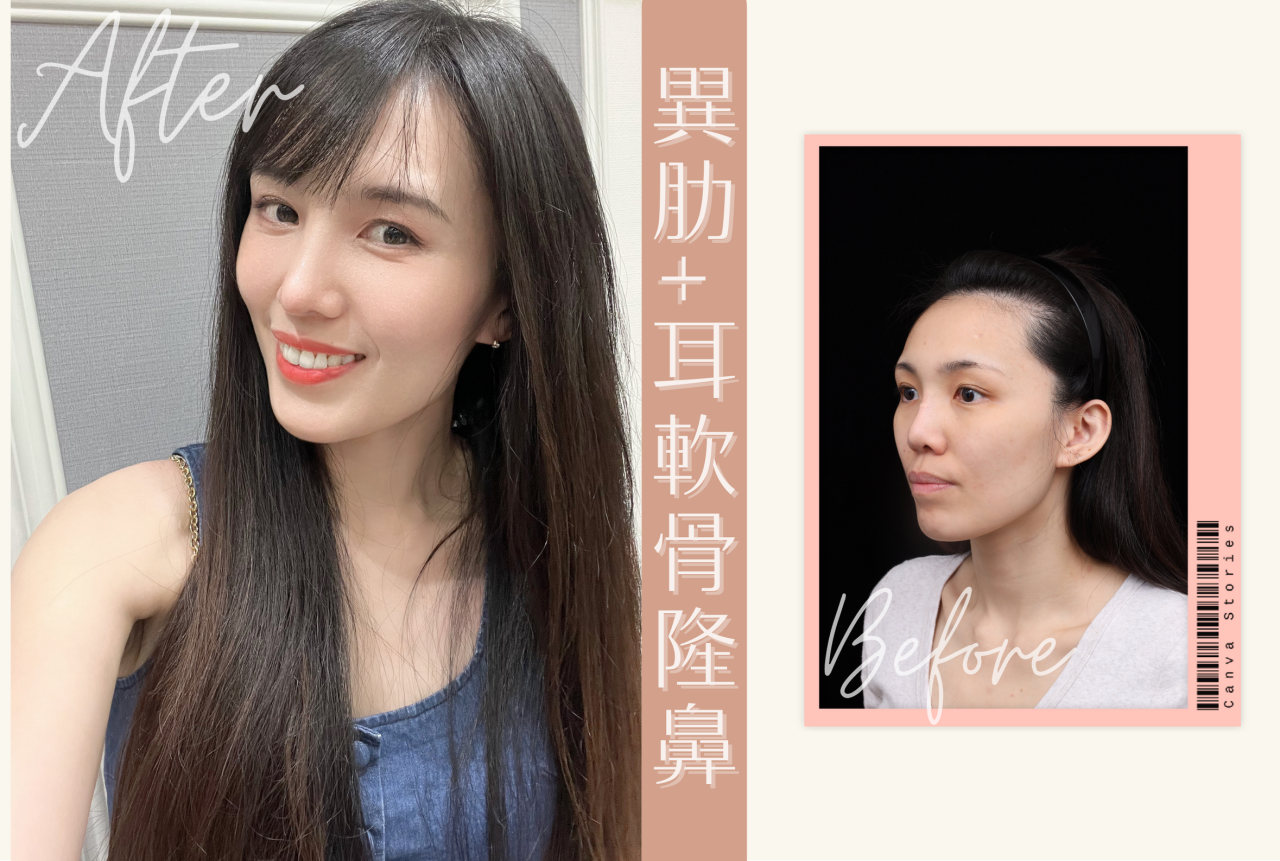 異肋+耳軟骨隆鼻打造我的韓式天生自然翹鼻！