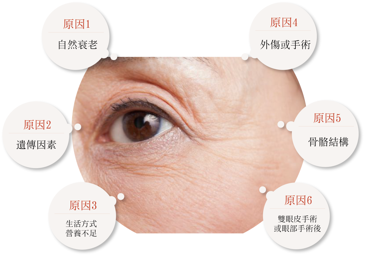 造成上眼眶凹陷的6大原因,你是哪一種?