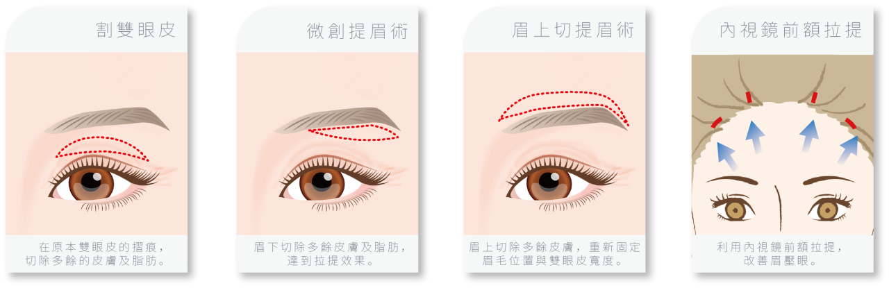 常見的解決老化性眼皮方式