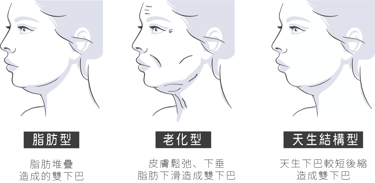 雙下巴種類分為：脂肪型雙下巴、結構型雙下巴、老化型雙下巴，你是哪一種？