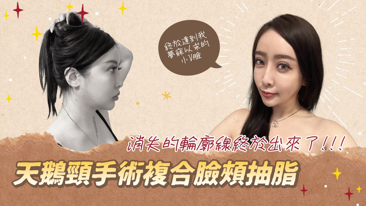 天鵝頸手術複合臉頰抽脂改善肉肉臉！我的側臉也太美!!