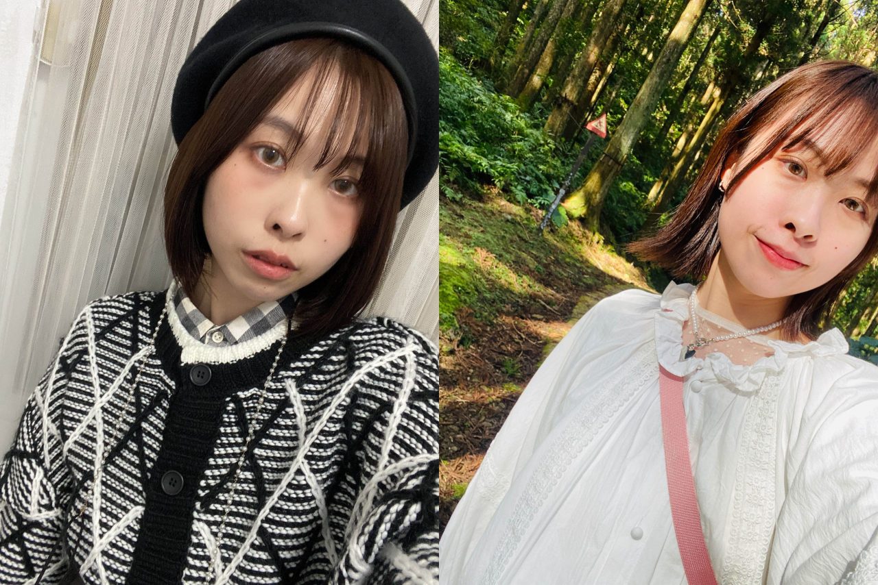遺傳性眼袋讓我看起來老5歲，術後終於不再需要遮瑕！