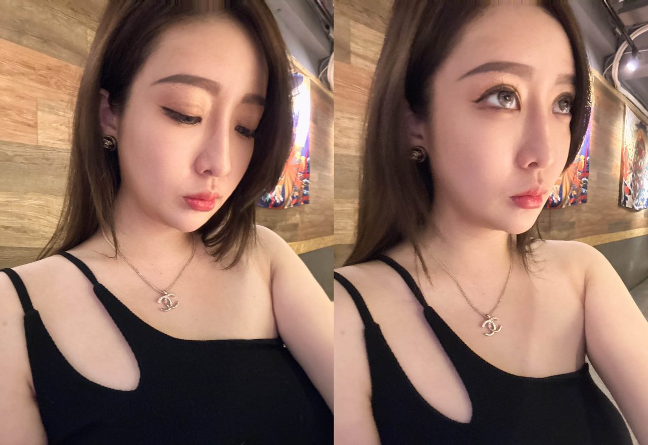 天鵝頸手術複合臉頰抽脂改善肉肉臉！我的側臉也太美!!