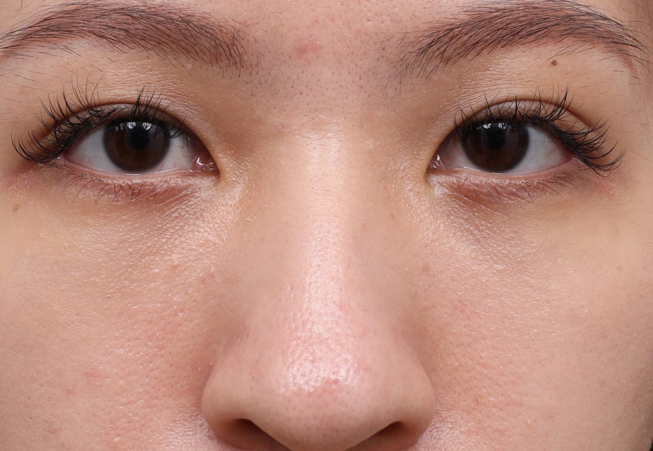 結構式眼袋解決讓我看起來又凶又疲憊的眼袋淚溝！
