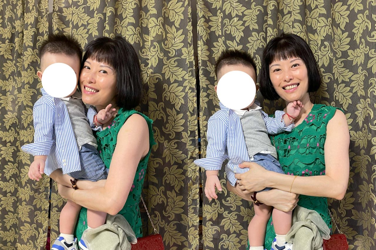 竟然不用眼袋外開就可以解決這樣的眼袋！結構式眼袋改善媽媽疲憊雙眼。