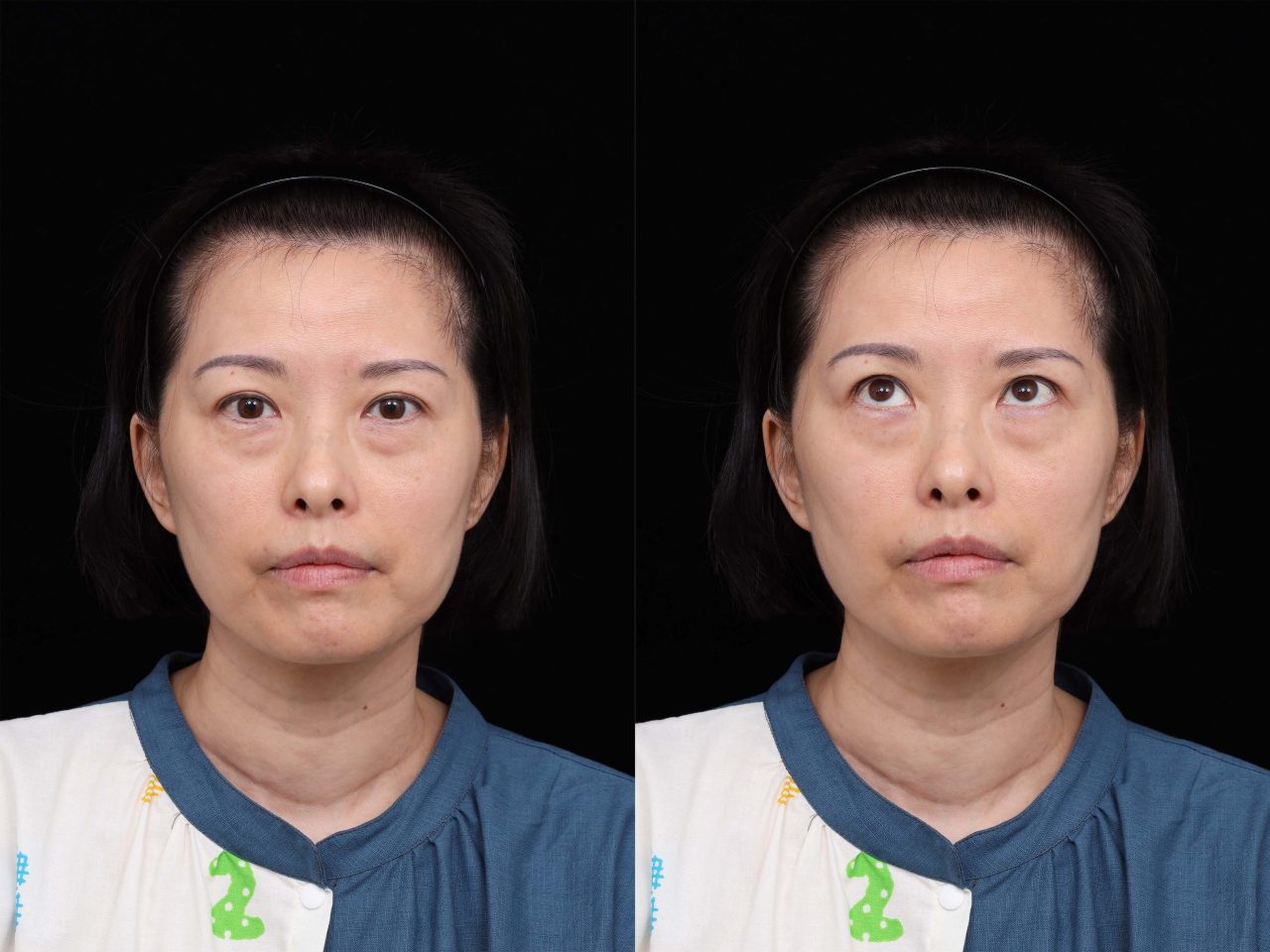 竟然不用眼袋外開就可以解決這樣的眼袋！結構式眼袋改善媽媽疲憊雙眼。