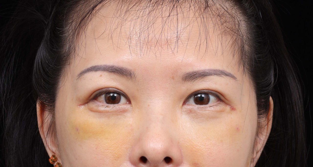 竟然不用眼袋外開就可以解決這樣的眼袋！結構式眼袋改善媽媽疲憊雙眼。