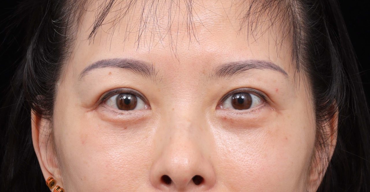 竟然不用眼袋外開就可以解決這樣的眼袋！結構式眼袋改善媽媽疲憊雙眼。