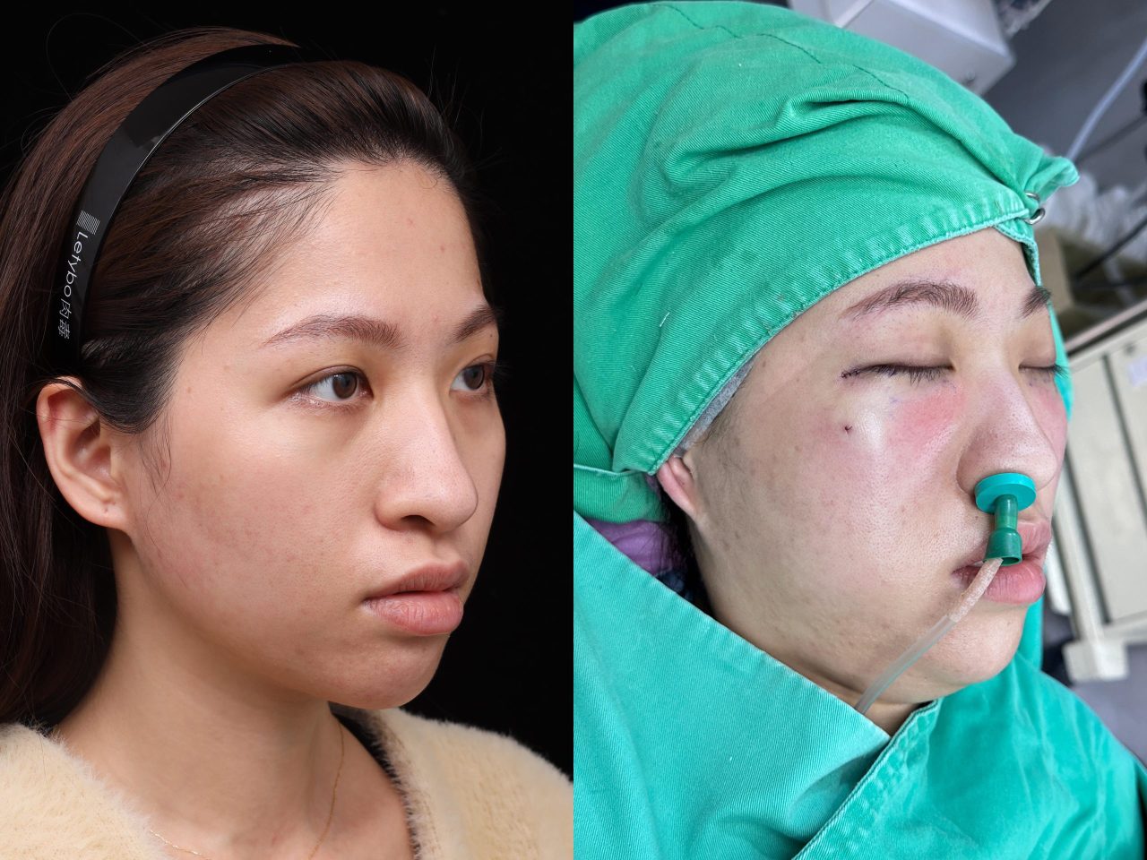 結構式眼袋解決讓我看起來又凶又疲憊的眼袋淚溝！