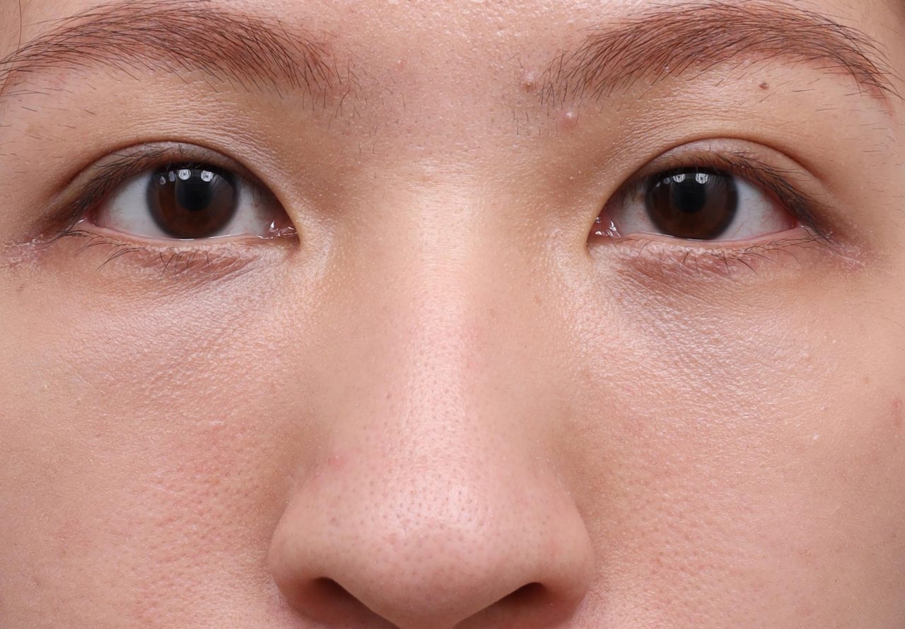 結構式眼袋解決讓我看起來又凶又疲憊的眼袋淚溝！