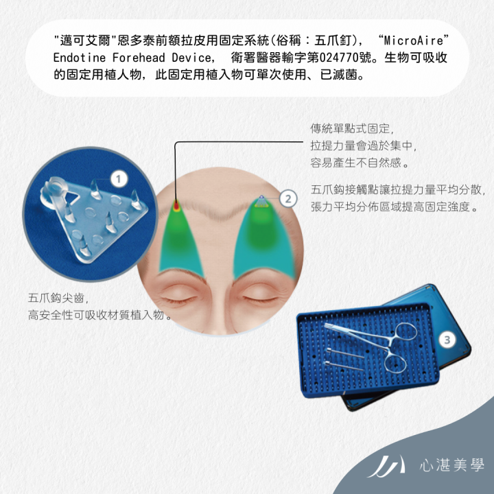 內視鏡隱痕五爪前額拉皮，五爪鉤接觸點讓拉提力量平均分散