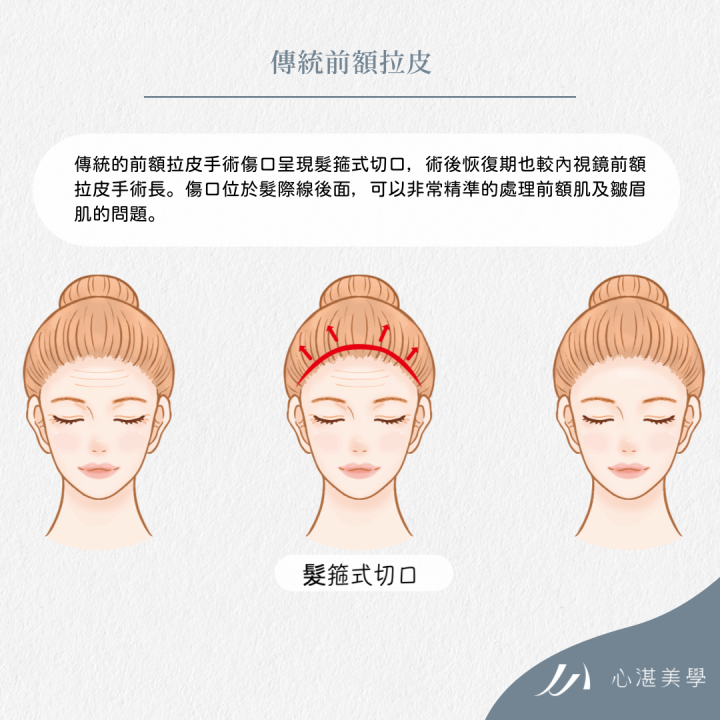 傳統前額拉皮手術方式，適合嚴重皮膚垂墜