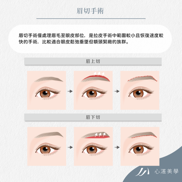 眉下切／眉上切手術，適合眉眼間距超過2.5CＭ且同時有眼皮垂墜困擾的人