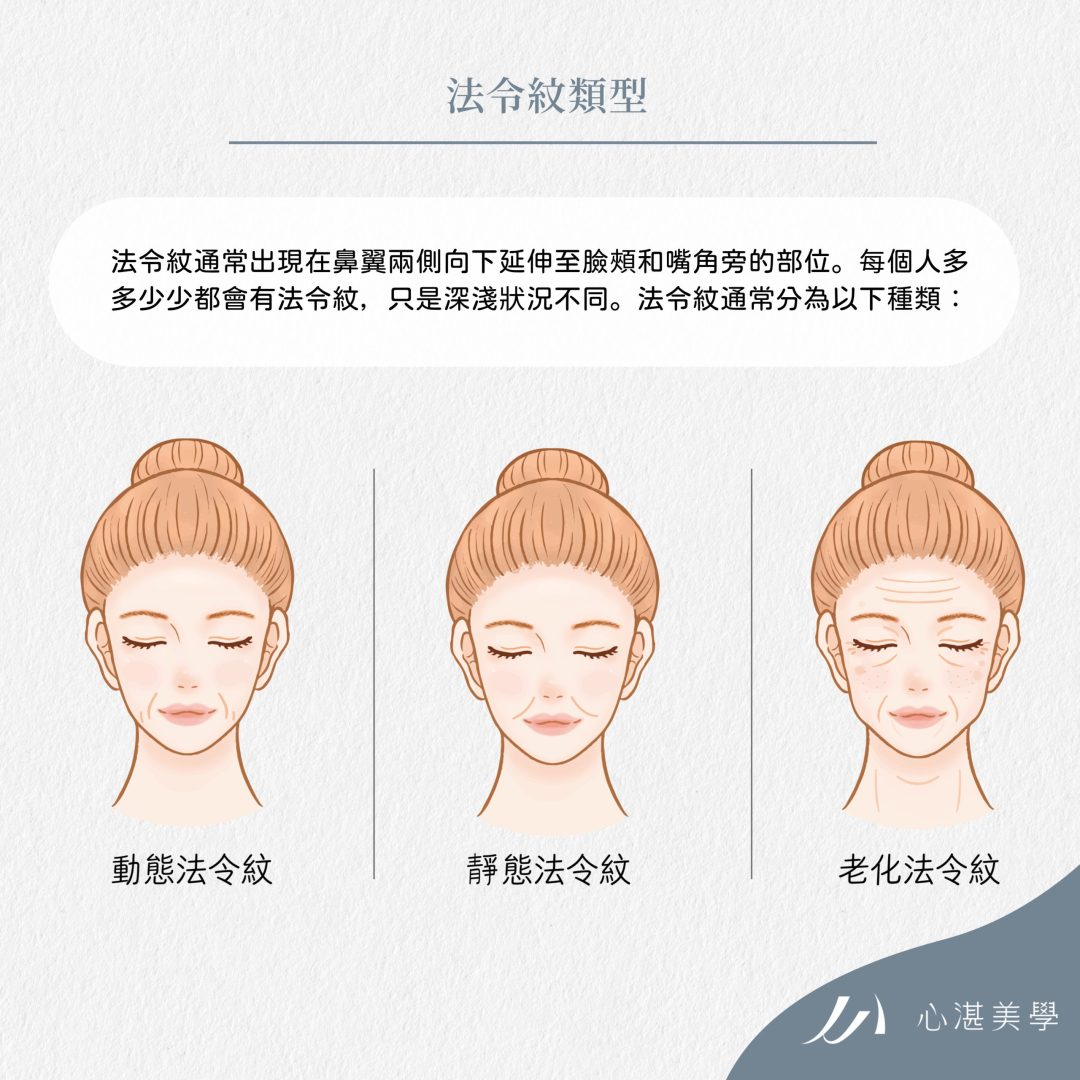 法令紋通常分成靜態法令紋、動態法令紋、老化型法令紋。法令紋的形成是多種因素綜合作用的結果。