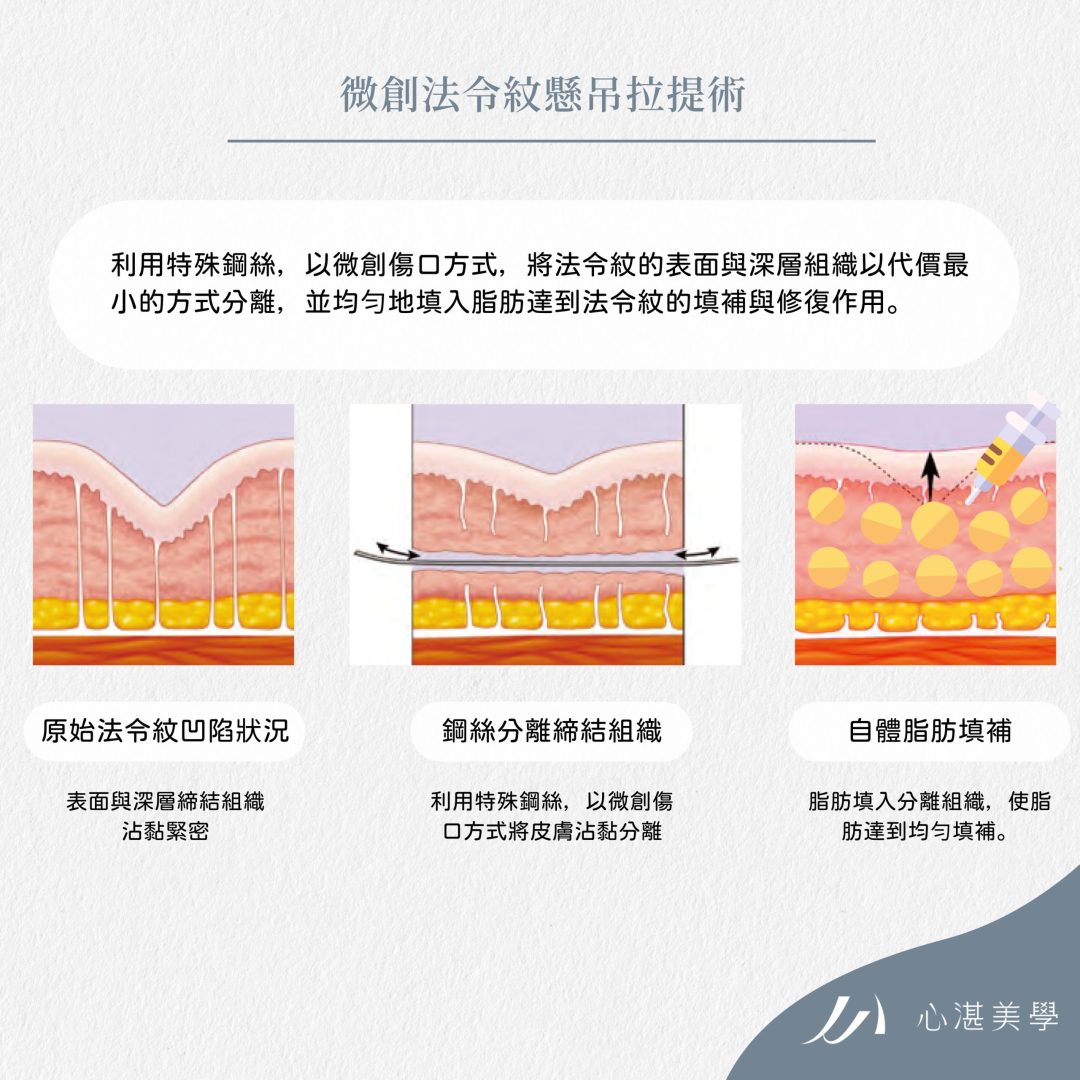 針刀無痕法令紋平滑術是什麼？為什麼可以達到半永久？手術療程原理說給你聽！