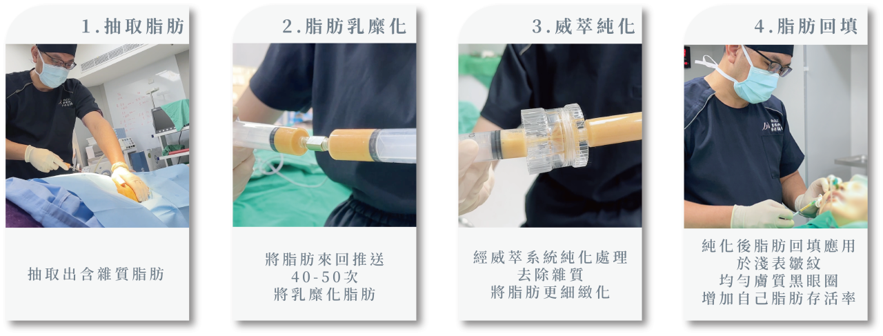 威萃脂肪溶液的使用步驟是：先抽脂，接著將脂肪與威萃混合，最後透過離心，分離出高品質的純脂肪進行回填。