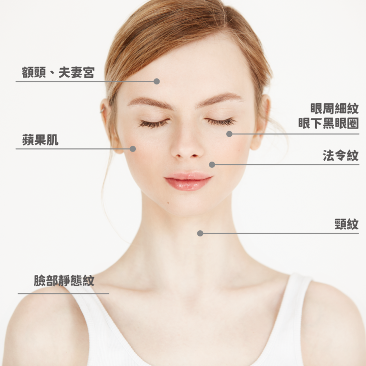 自體脂肪回填範圍:額頭、法令紋、眼周、太陽穴、蘋果肌、下巴等部位。