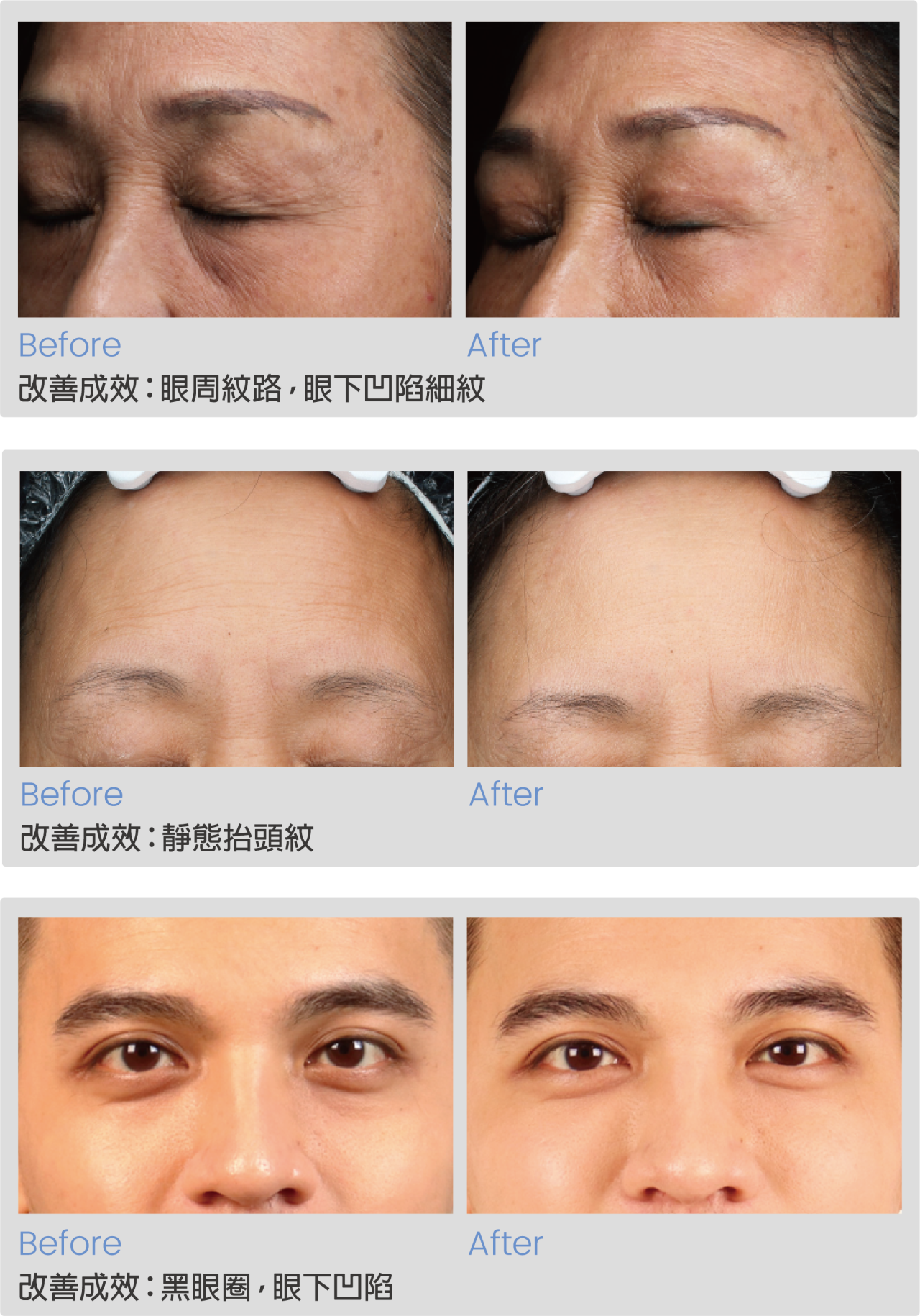 威萃術後對比圖顯示，臉部凹陷處變得飽滿平順，氣色更好，整體視覺效果年輕自然，改善了術前的憔悴感。