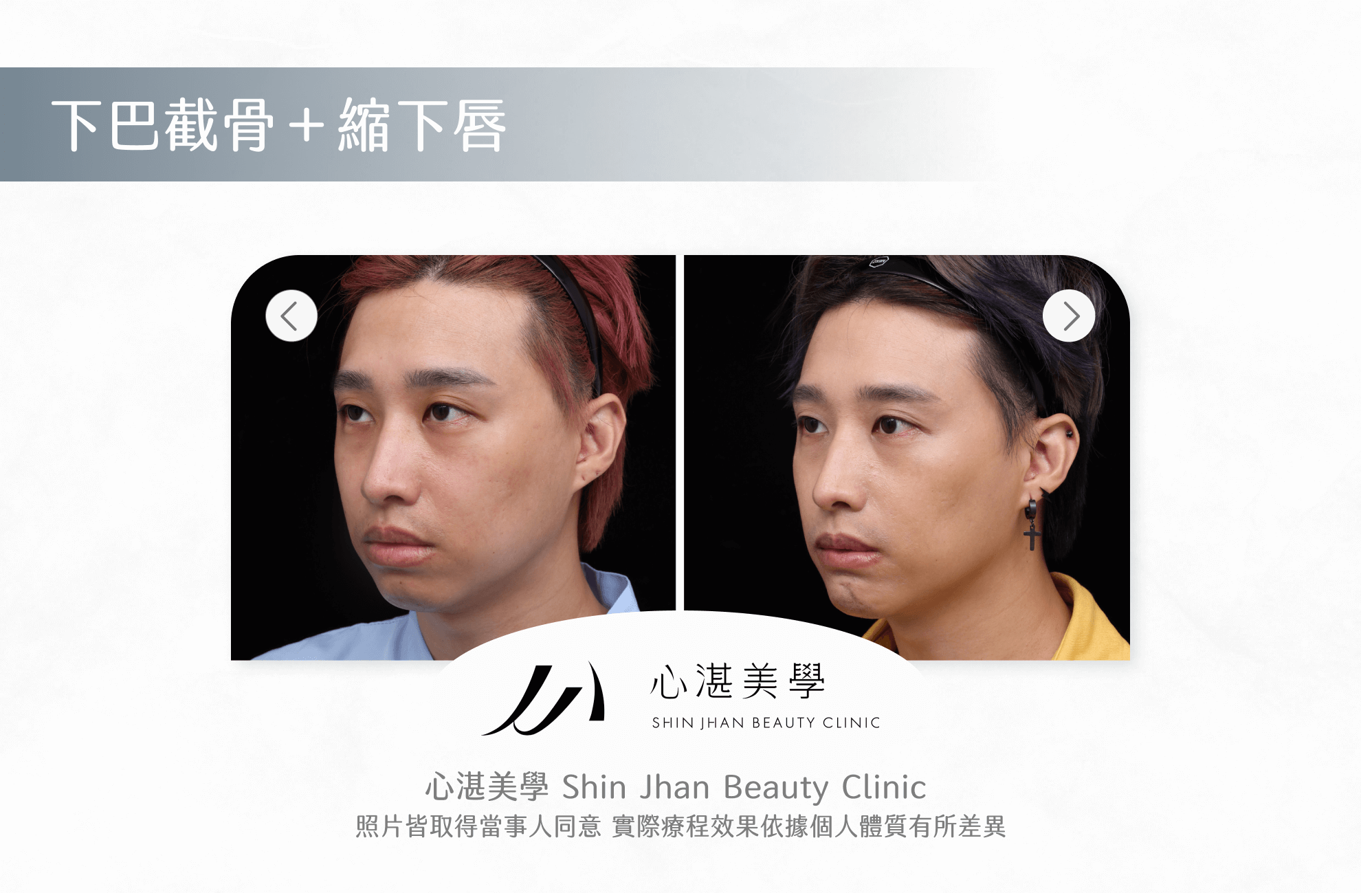下巴截骨案例圖