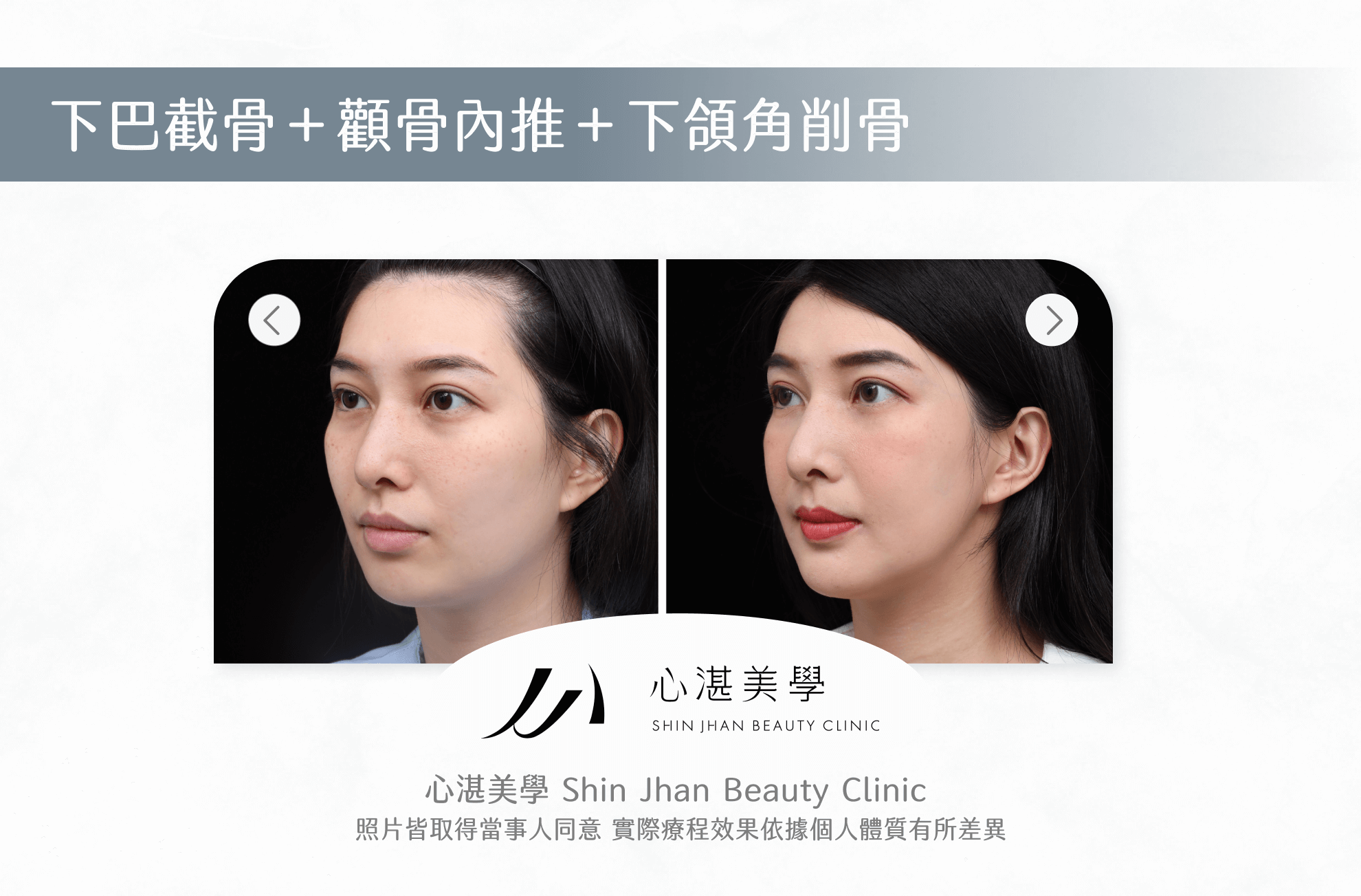 下巴截骨案例圖