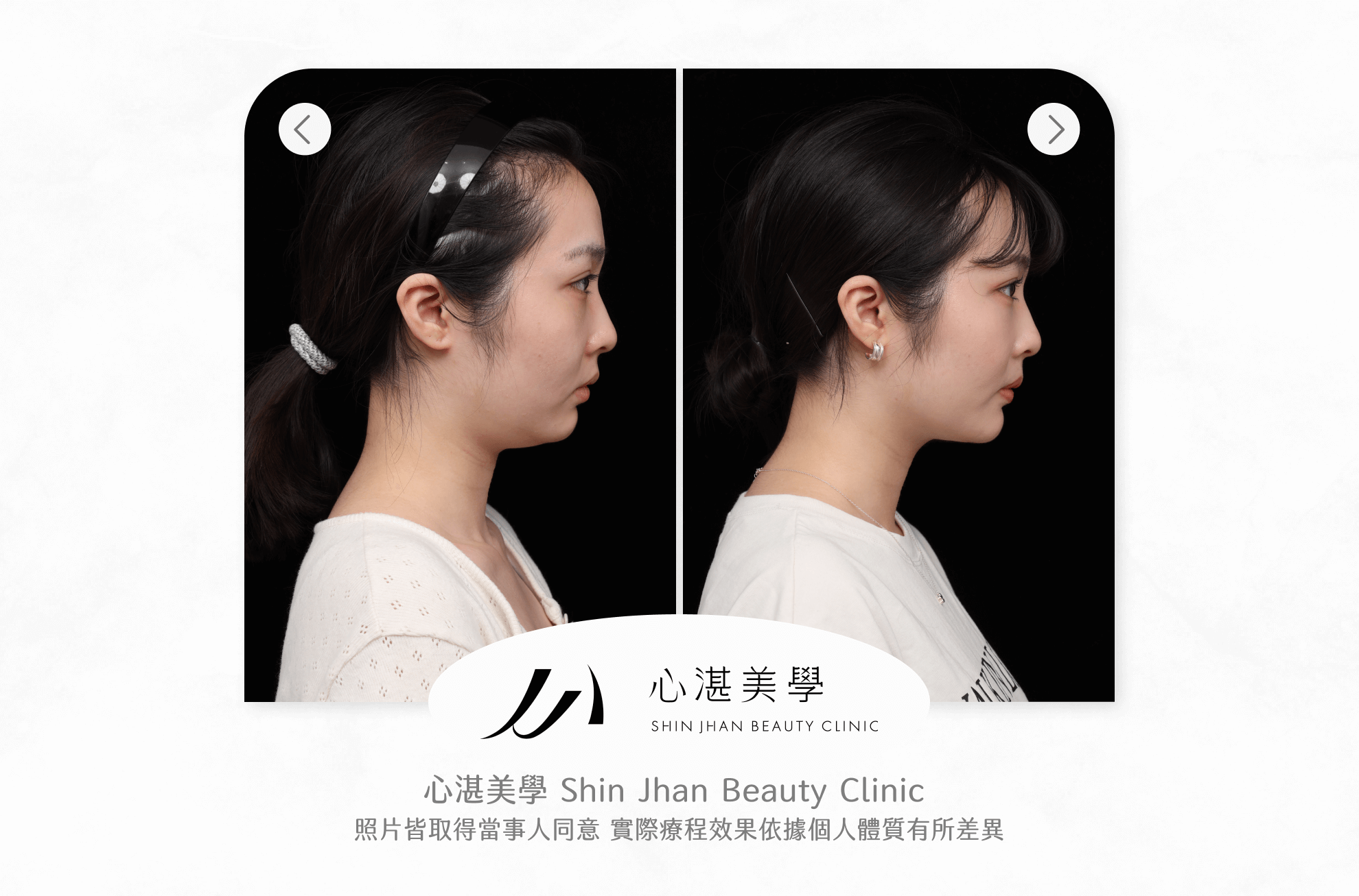 天鵝頸案例圖