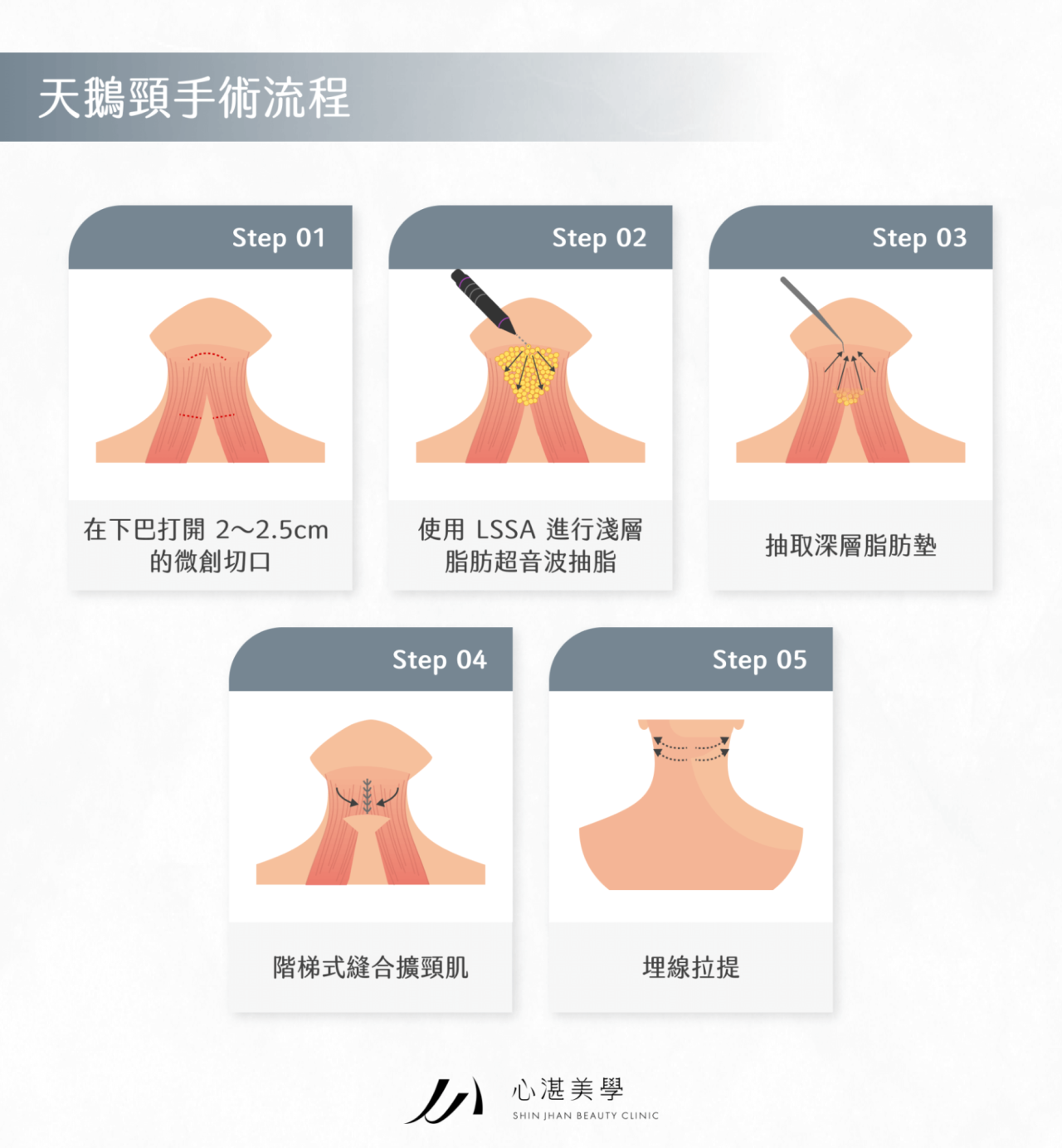 天鵝頸手術_下巴抽脂_闊頸肌縫合_下頷線_小臉拉提示意圖