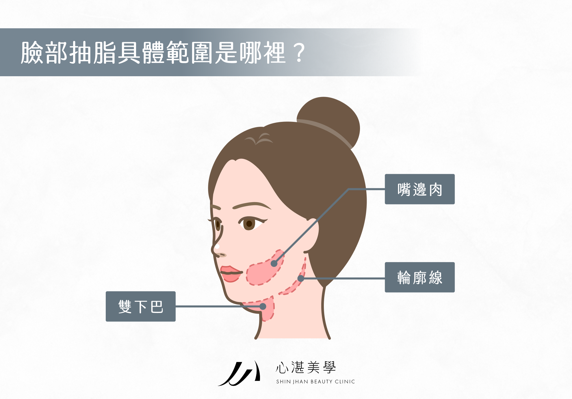 臉部抽脂範圍
