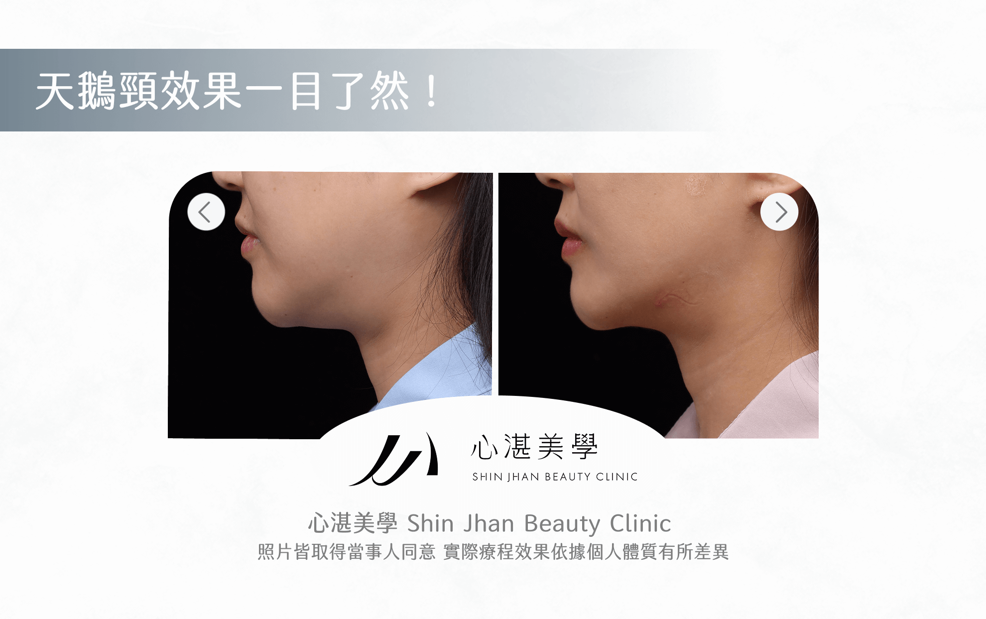 天鵝頸是什麼