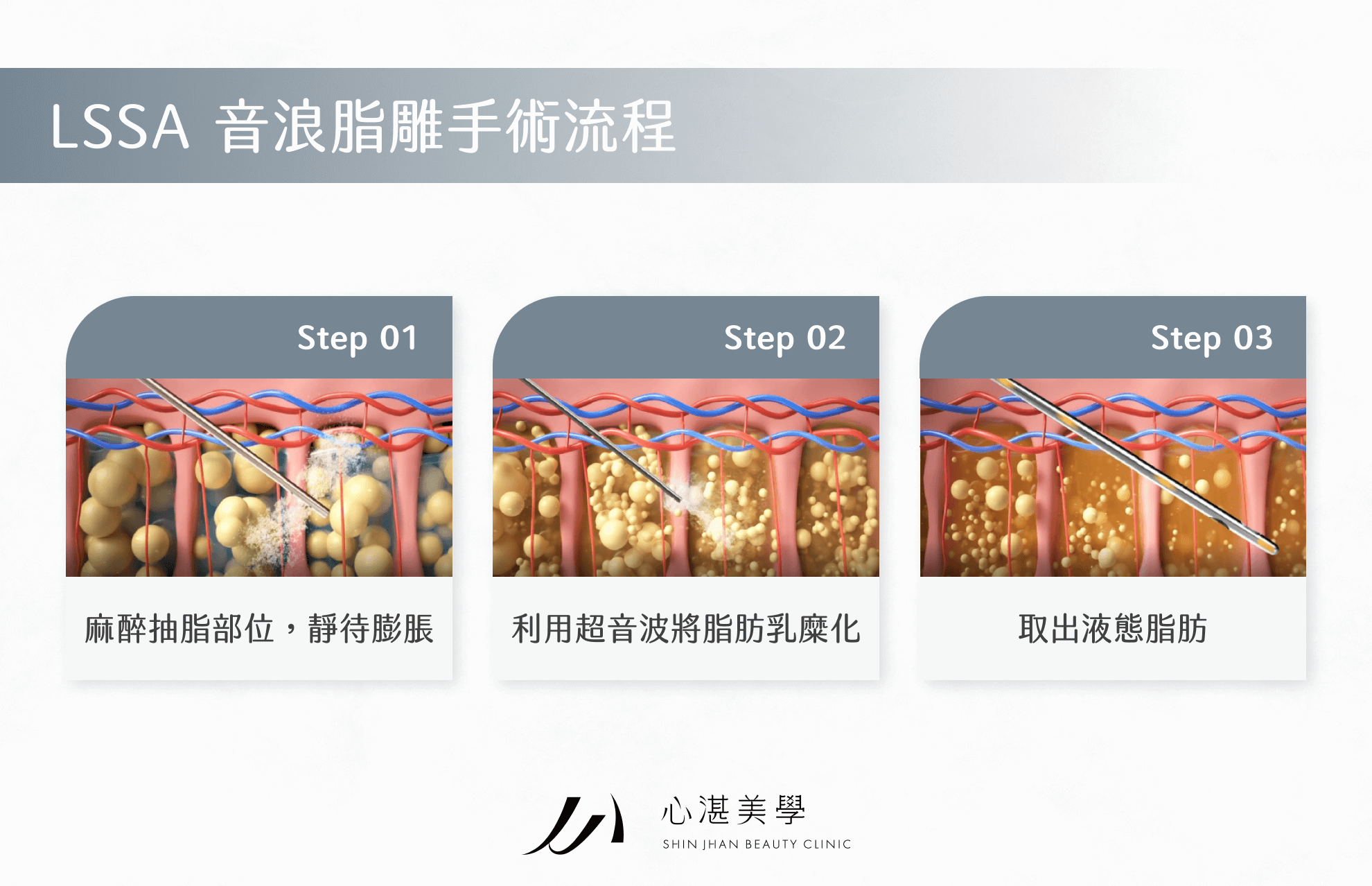 LSSA 音浪脂雕手術流程