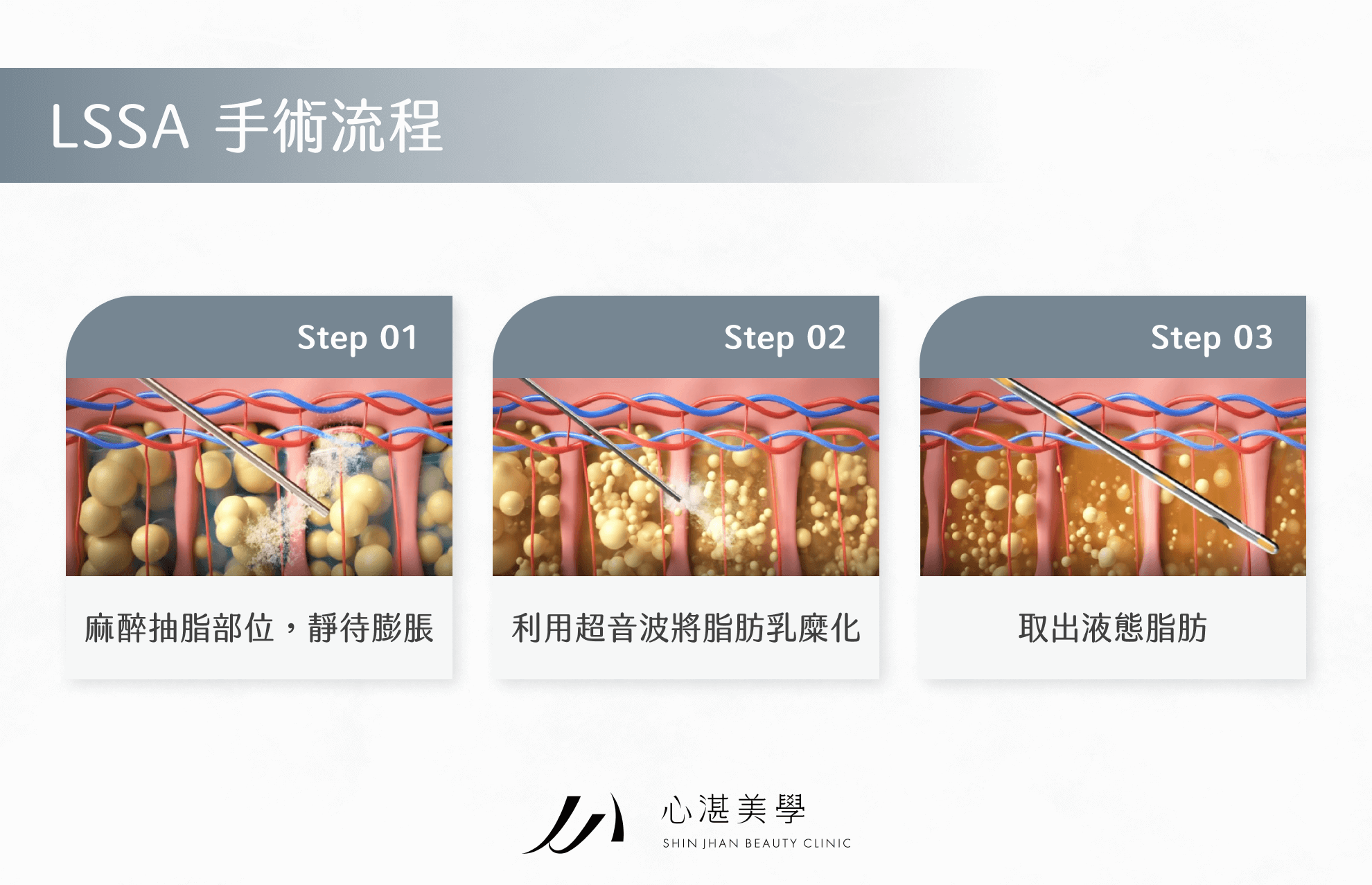 LSSA 手術流程