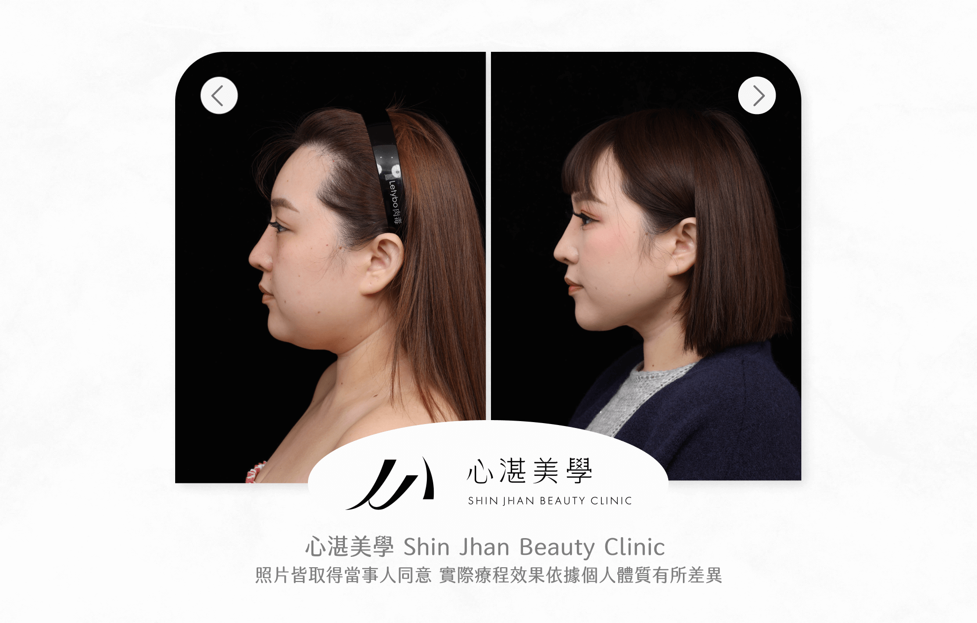 臉部抽脂案例