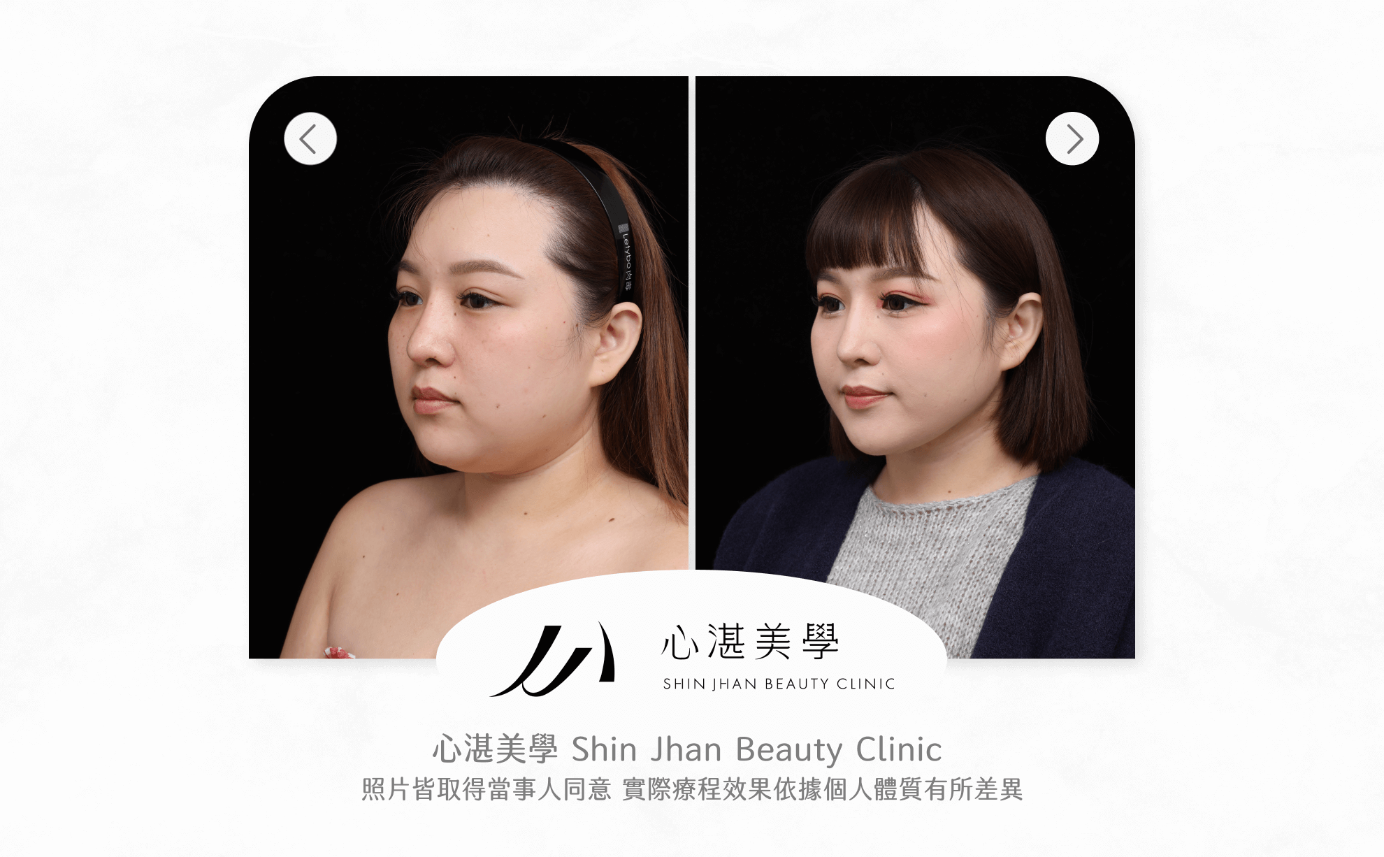 臉部抽脂案例