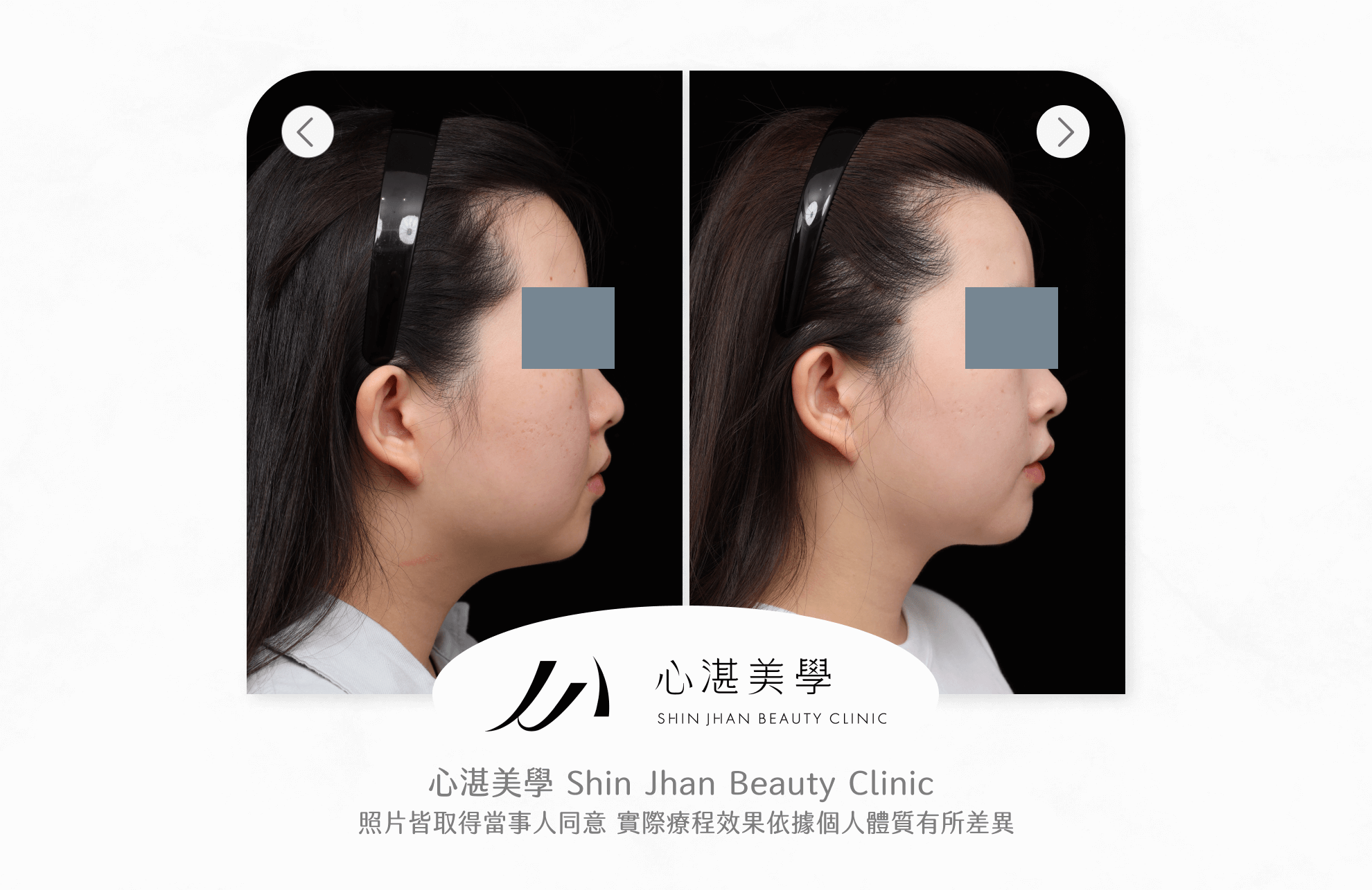 臉部抽脂案例
