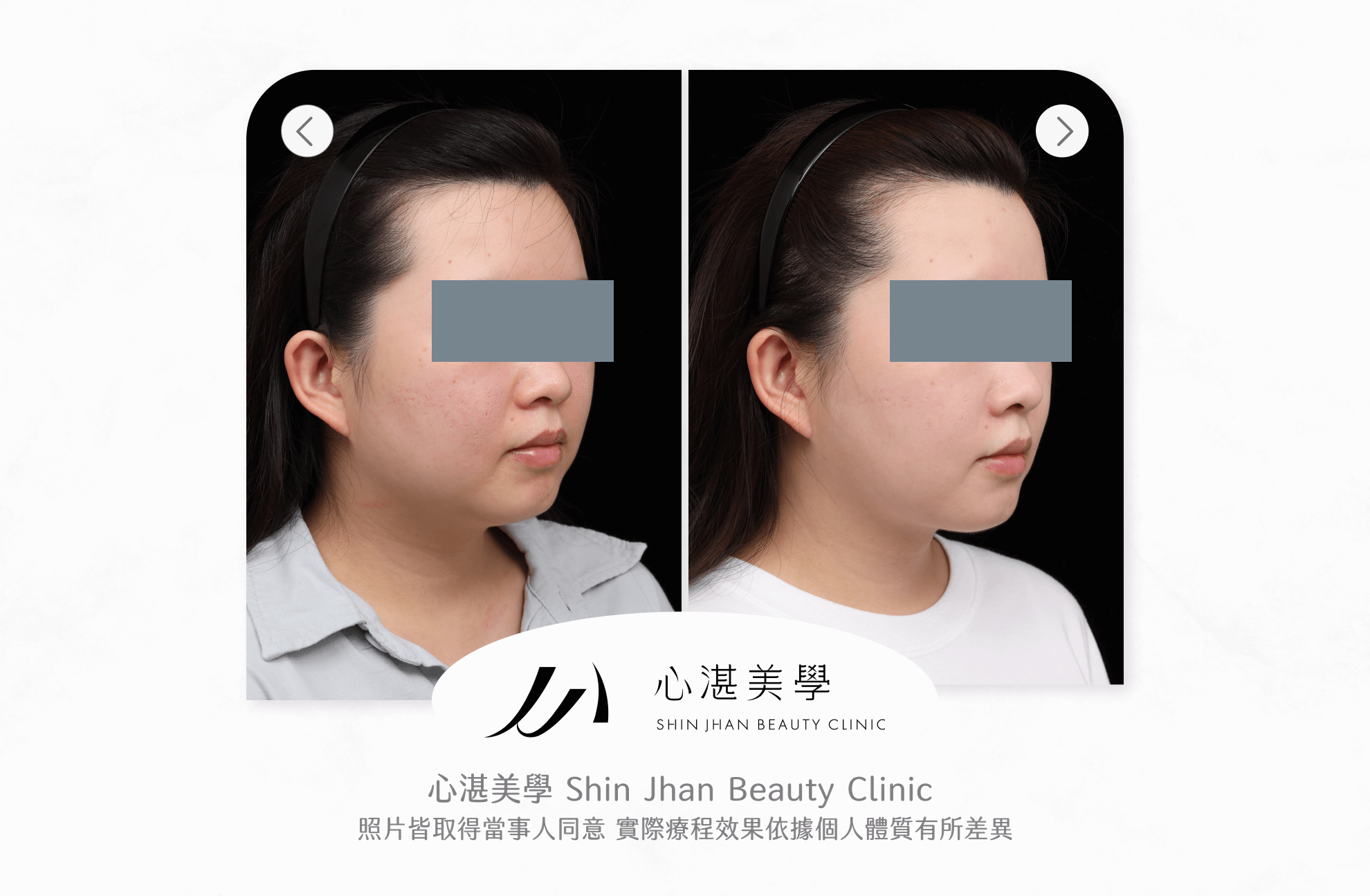 臉部抽脂案例