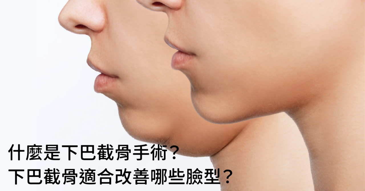 什麼是下巴截骨手術？下巴截骨適合改善哪些臉型？