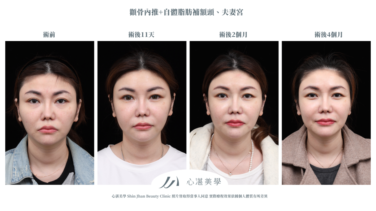 顴骨內推+自體脂肪補額頭夫妻宮案例分享