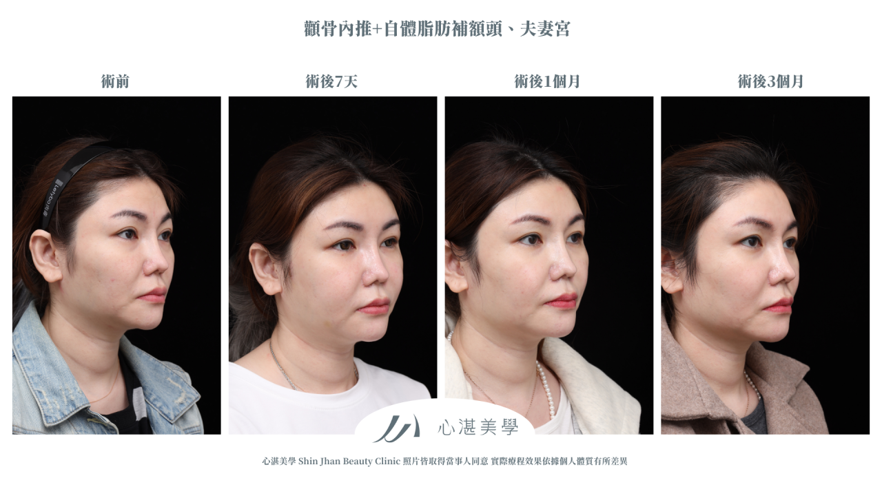 顴骨內推+自體脂肪補額頭夫妻宮案例分享