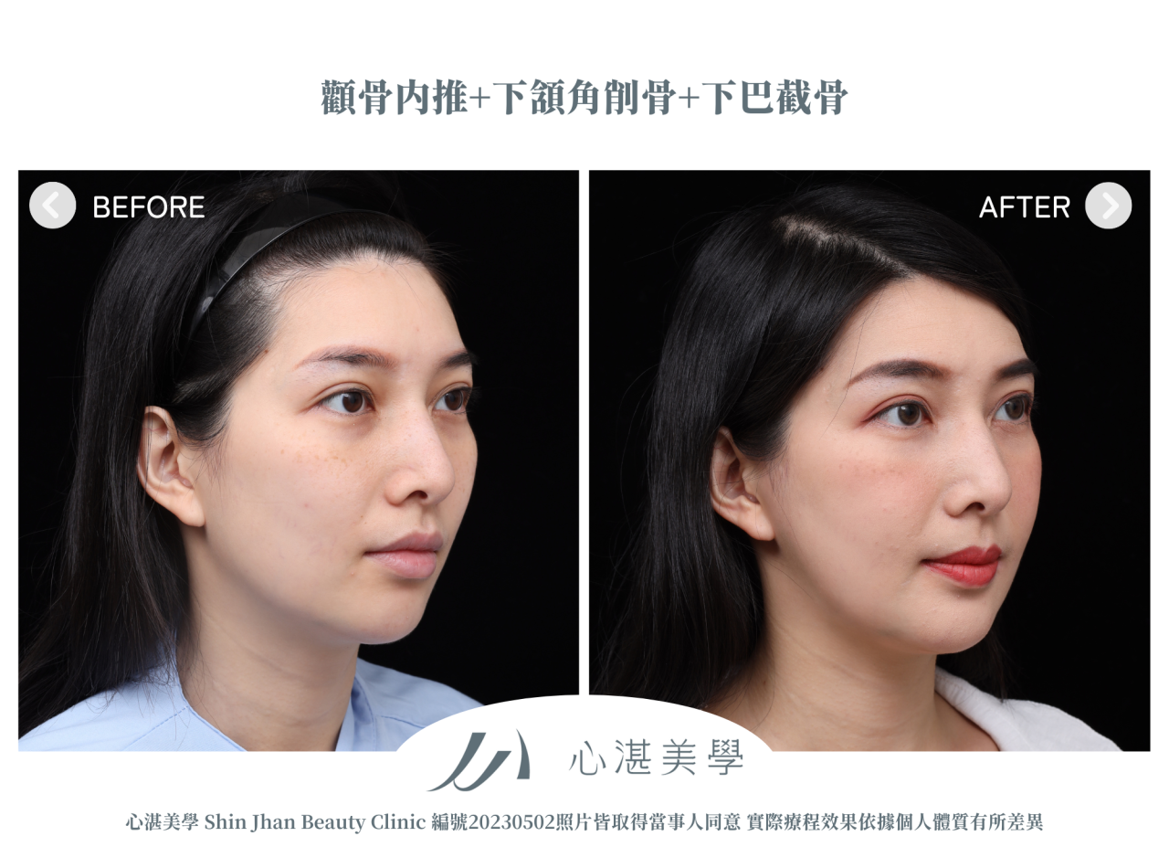 顴骨內推+下頷角削骨+下巴截骨案例分享