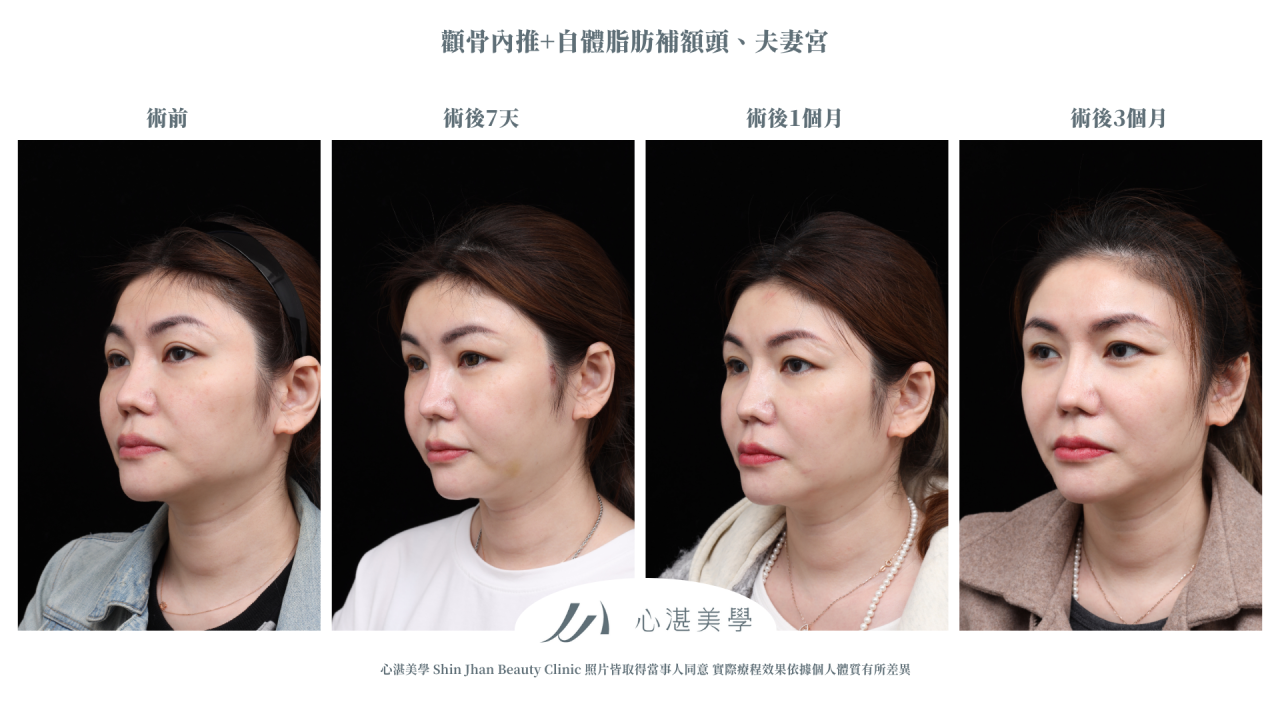 顴骨內推+自體脂肪補額頭夫妻宮案例分享