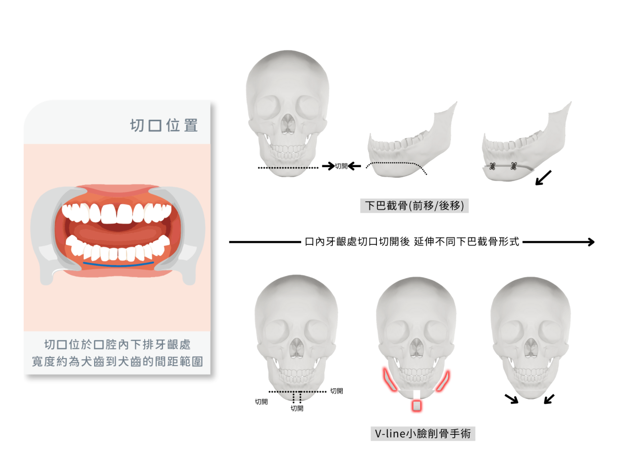 下巴截骨手術的傷口在口腔內側，不需拆線，縫線會自行溶解。這樣術後外表看不到疤痕，更美觀。