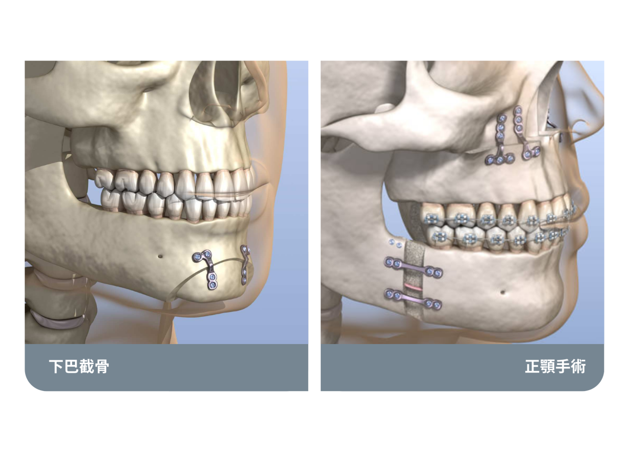 下巴截骨手術是針對下巴形狀的局部調整，改善下巴過長、後縮或不對稱，與主要改善咬合問題的正顎手術不同。若無咬合問題，下巴截骨就能有效美化臉型。