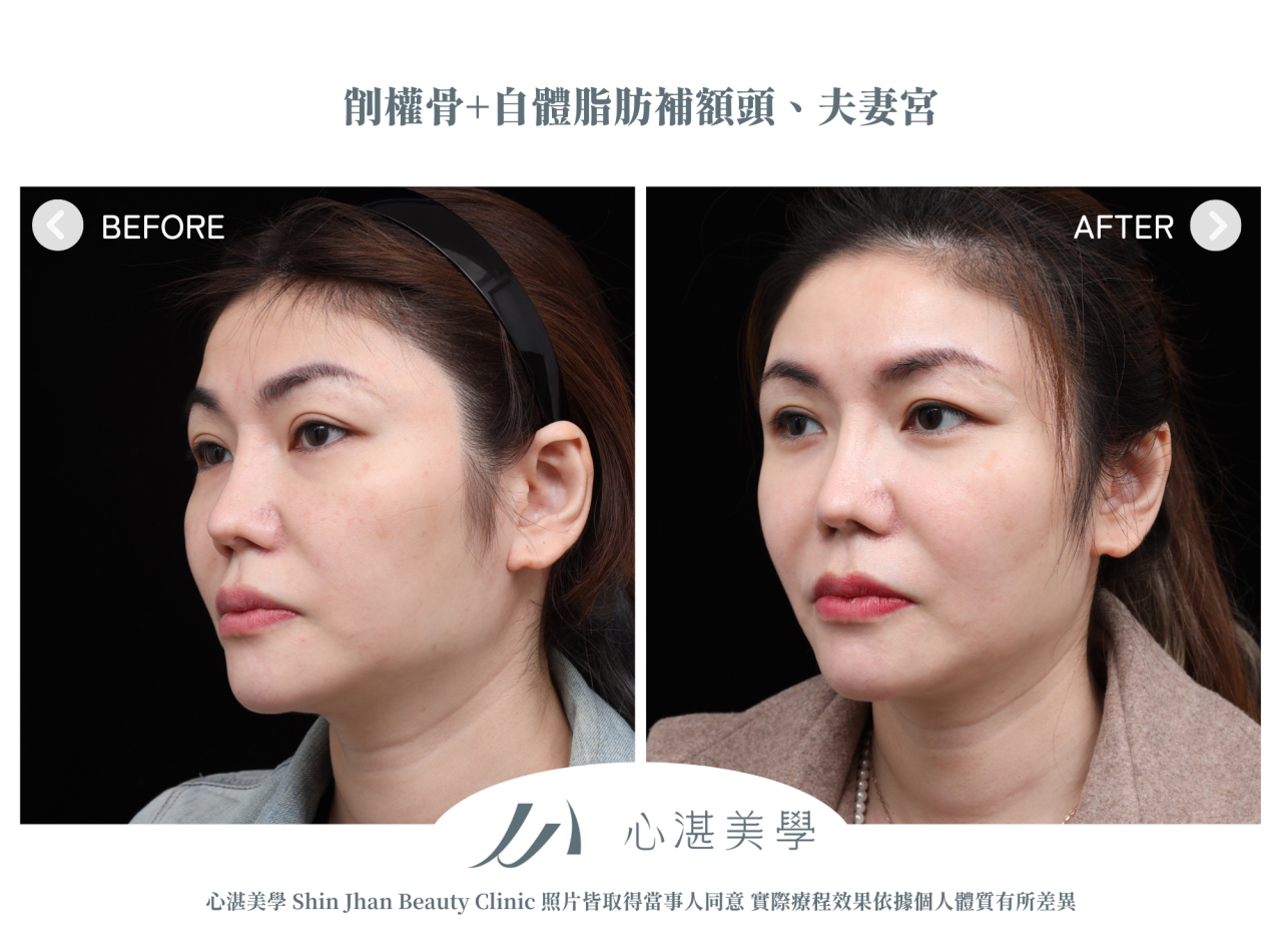 顴骨內推+自體脂肪補額頭夫妻宮案例分享